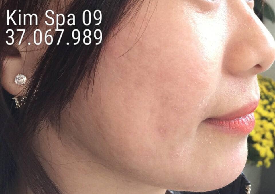 vLiệu trình trị mụn uy tín tại Bảo Lộc